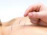 Acupuncture for Beginners