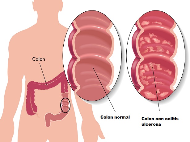 Remedios caseros para la colitis